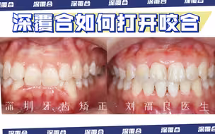 重度深覆合如何打开咬合?
