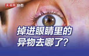 掉进眼睛里没出来的异物去哪了？医生：还在眼睛里