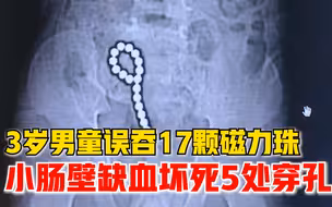 3岁男童误吞17颗磁力珠小肠穿孔：腹痛十几天，手术1小时取出