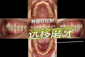 种植钉控制远中移动磨牙