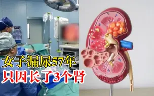 女子漏尿57年只因长了3个肾：手术切除1个后恢复正常