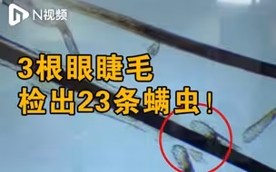 3根眼睫毛检出23条螨虫！东莞医生提醒跟这习惯有关