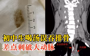 初中生喝汤误吞排骨差点刺破大动脉：排骨两头尖锐，长约3厘米