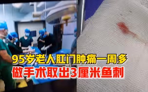 95岁老人肛门肿痛取出3厘米鱼刺，医生：扎破重要脏器将危及生命
