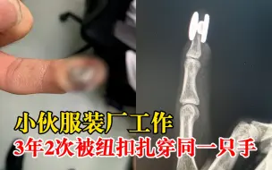 小伙服装厂工作3年2次被纽扣扎穿手：不及时手术手指可能坏死