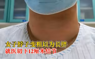 女子甲状腺长12厘米结节压进胸腔：发病3年，一直以为是长胖