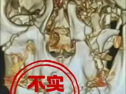 邯郸初中生遇害案，网传颅骨照片不实