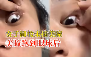 女子卸妆未摘美瞳跑到眼球后：很痛，后来流眼泪才冲出来