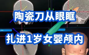惊险！陶瓷刀从眼眶扎进1岁女婴颅内，上海专家从1岁女婴颅内取出4厘米断刀