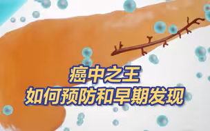 胰腺癌被称为癌中之王 导致胰腺癌的四个高危因素