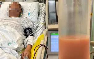 男子饮下冰镇饮料后被送进ICU 医生在其血液中透析出一大袋油脂