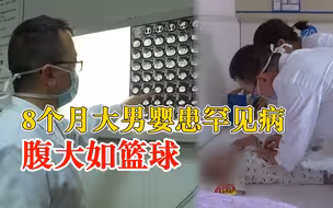 8个月大男婴患罕见病腹大如篮球，医生：发病率约为万分之一
