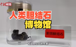 人类胆石研究博物馆你见过吗？成都一医院希望通过科普降低发病率