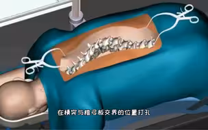 这是最暴力的手术吧，脊柱侧弯传统矫正手术过程，3D演示。。