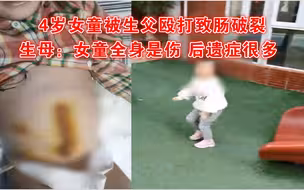 4岁女童被生父殴打致肠破裂,生母:没有医生救助,女儿没了都不知道