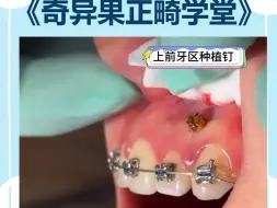 正畸上前牙种植钉植入与加力