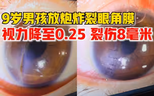 深圳9岁男孩放炮炸裂眼角膜，医生：视力降至0.25，角膜裂伤8毫米