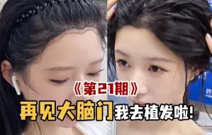再见我的大脑门，我去植发了！