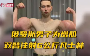 俄罗斯男子为增肌双臂注射6公斤凡士林