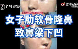 女子肋软骨隆鼻致鼻梁下凹：要求医院恢复原貌