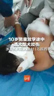10岁男童放学途中遭大型犬咬伤 涉事犬只主人垫付1万医药费
