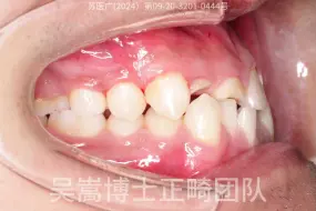 深覆合+牙弓塌陷+重度拥挤