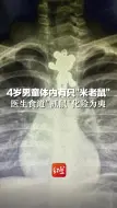 4岁男童体内有只
