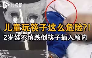 男童手握筷子跌倒从口腔刺入颅内3厘米，医生：极易引起动脉大出血