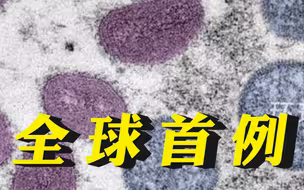 全球首例！意大利男子同时感染猴痘、新冠和艾滋病病毒