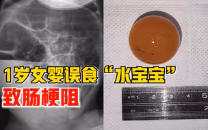 1岁女婴误食水宝宝致肠梗阻，医生紧急开腹手术取出