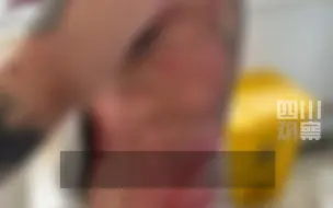 女子SPA会所拨火罐，技师操作不当打翻酒精，致上身被三度烧伤