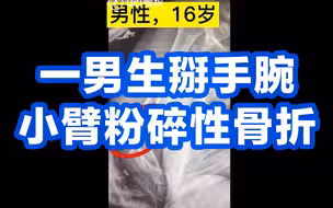 上海一男生掰手腕小臂粉碎性骨折，医生：切不可用力过猛