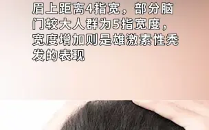 正常发际线为眉上距离4指宽 你合格了吗？