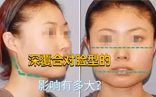 深覆合对脸型的影响有多大？