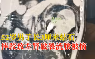 52岁男子摔跤致左肾破裂被摘：3厘米结石堵住输尿管，肾积水严重