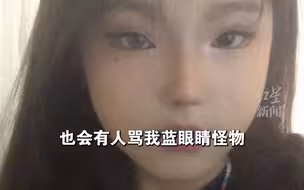 18岁女孩一只眼天生蓝色，曾因被骂怪物而自卑