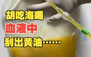 男子胡吃海喝多日后腹痛难忍送医抢救 医生从其血液中刮出一大袋“黄油”