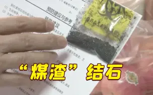 一天吃5、6个鸡蛋还很少喝水，男子胆囊长满“煤渣”结石