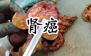 又噶腰子了！肾癌来科普，清楚的看看肾癌长什么样子！