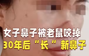 女子鼻子被老鼠咬掉 30年后终于“长”出新鼻子