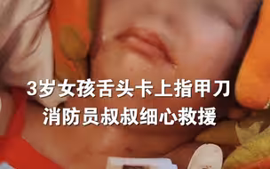 3岁女童舌头被卡指甲刀，消防员叔叔细心救援。