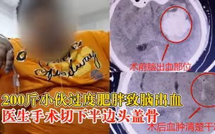 200斤小伙过度肥胖致脑出血险丧命，医生手术3小时切下半边头盖骨