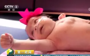 【第一时间】罕见！心脏长在体外  女婴手术后奇迹存活
