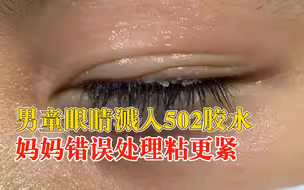 8岁男童做手工眼睛被502胶水粘住，妈妈一番操作促使粘得更紧