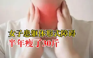 女子患躯体形式障碍半年瘦了30斤：过分关注躯体症状，感觉症状多