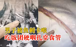 男子鱼刺卡喉吃饭团硬咽扎穿食管：险些刺破胸主动脉