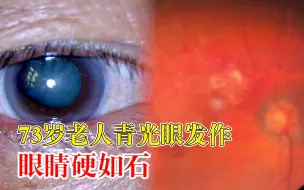 73岁老人患眼疾眼硬如石：确诊青光眼，眼压超正常值2倍多