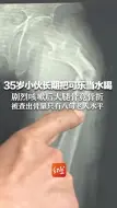 35岁小伙长期把可乐当水喝，剧烈咳嗽后大腿骨竟骨折，被查出骨量只有八旬老人水平