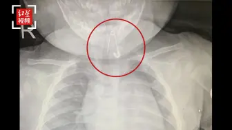 惊险！7月龄男婴吞下一枚开口别针卡在食道口，针尖还朝下
