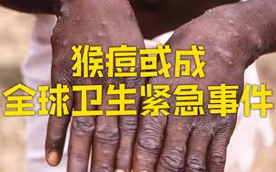 世卫组织考虑宣布猴痘疫情为全球卫生紧急事件